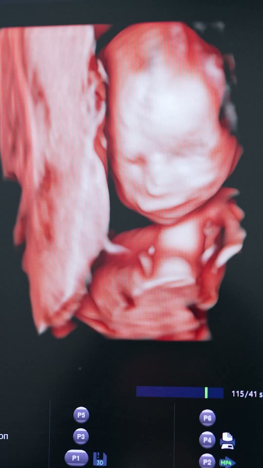 Ultrassonografia obstétrica em 3D